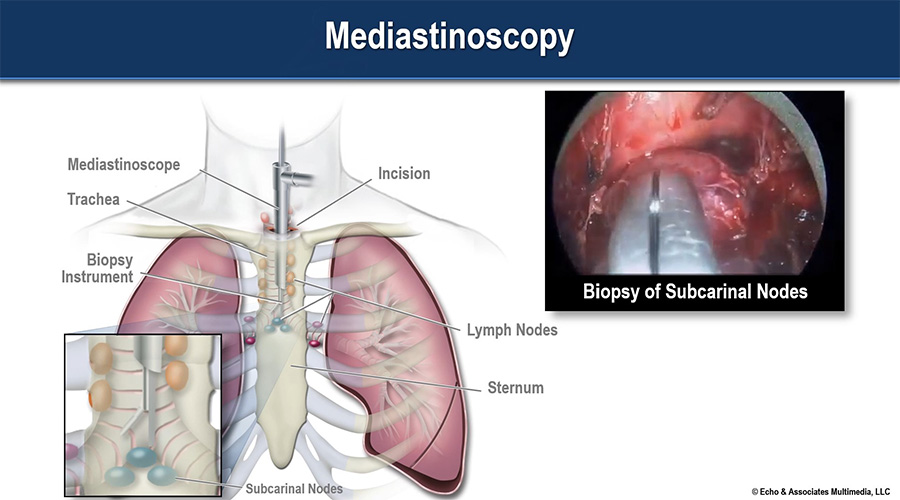 Video mediastinoscopy biopsy
